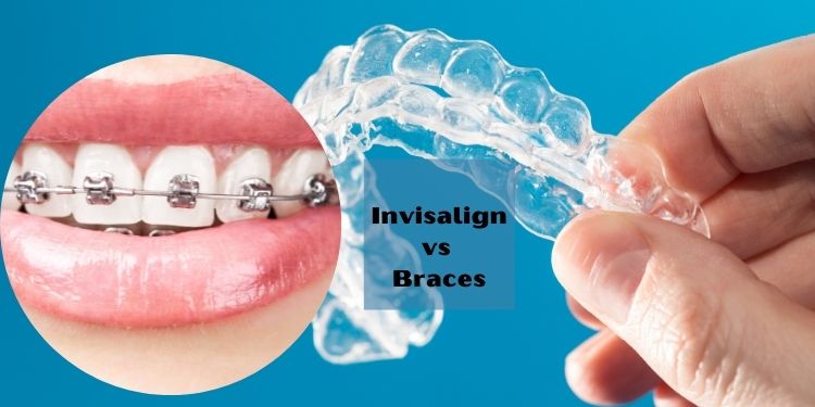 Invisalign vs Braces: What Is Best for You